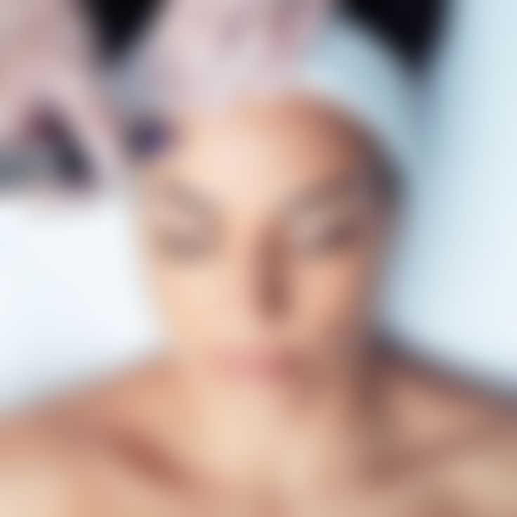 Microneedling
