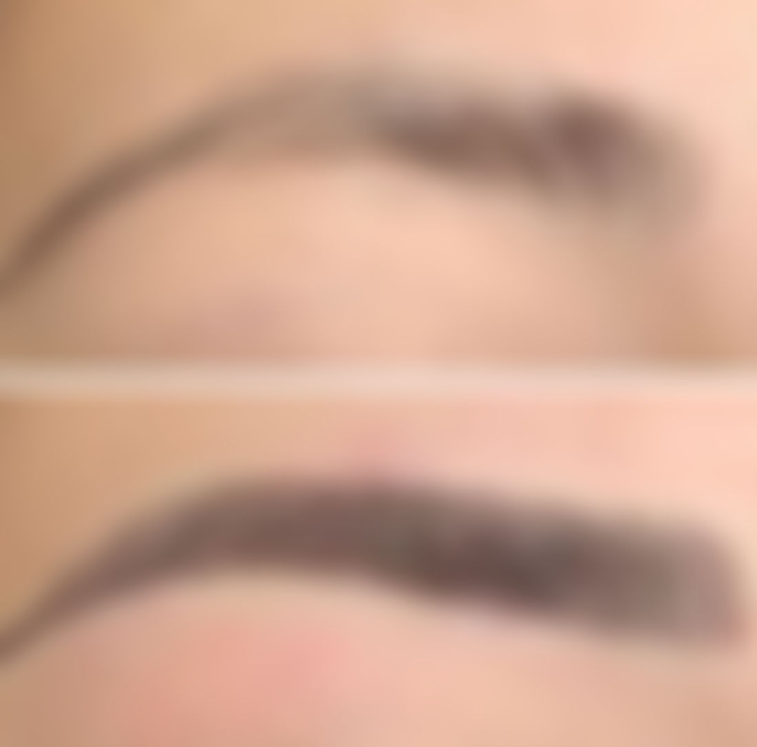 Microbalding