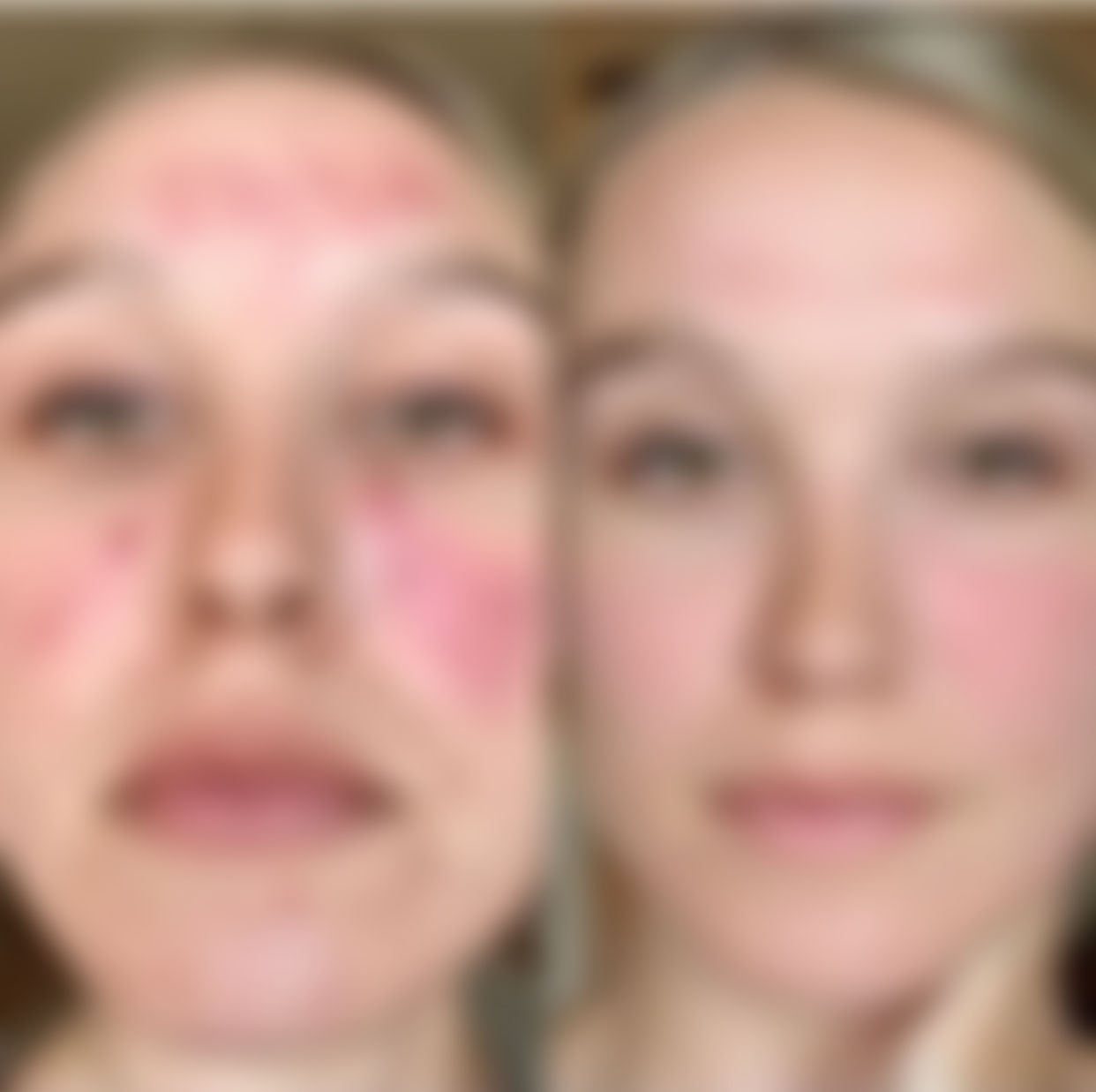 Chemical Peel Treatments