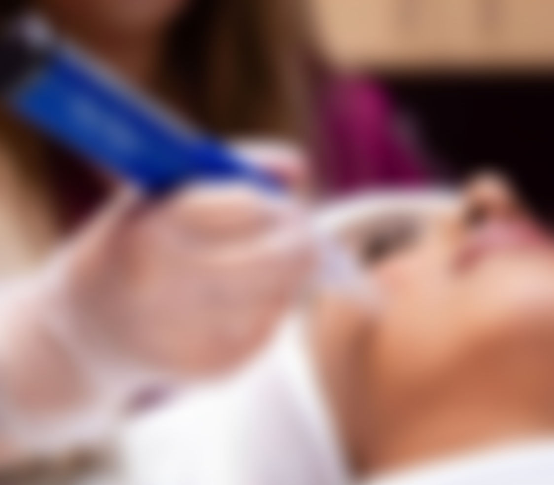 Microneedling