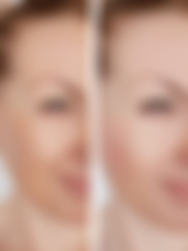 Skin Rejuvenation/Remodeling