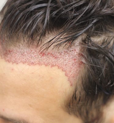 Hair transplant Dubai - 1 Photos & 0 Reviews - Beauty - Spa - Villa 927 A, Al Wasl Rd, Umm Seqiem, Al Manara Area . No. 57394, Dubai, UAE - TOPGOOGLE Hair transplant Dubai - 1 Photos & 0 Reviews - Beauty - Spa - Villa 927 A, Al Wasl Rd, Umm Seqiem, Al Manara Area . No. 57394, Dubai, UAE - TOPGOOGLE