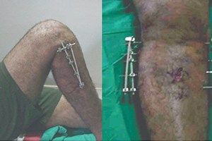 Best Ortho Specialist Hospital in Coimbatore | Orthopedic Treatment in India – VGM Ortho Centre