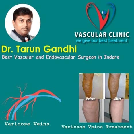 Vascular surgery specialist in Indore | Dr Tarun Gandhi