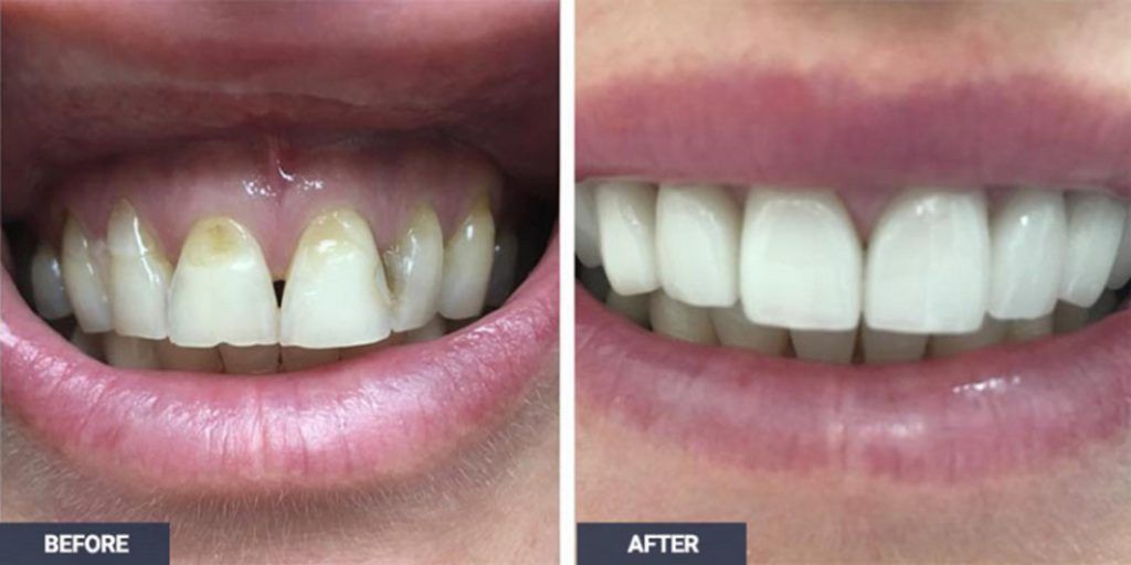 Implant Dentures