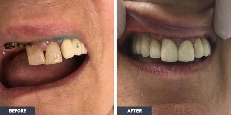 Denture Implants