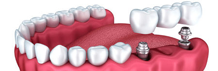 Zirconia Crowns Brooklyn