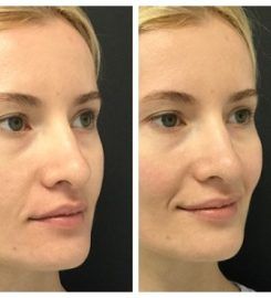 Oxygen & Deep Cleaning Facial