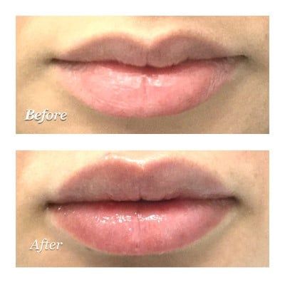 Hyperpigmentation Face & Acne Treatment