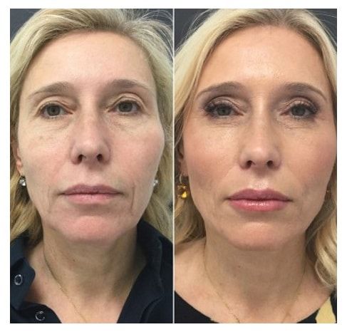 Oxygen & Deep Cleaning Facial