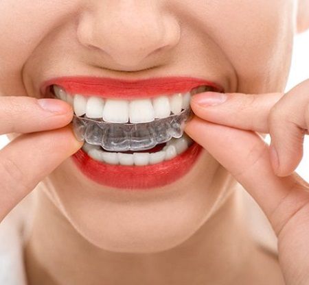 Invisalign Brooklyn