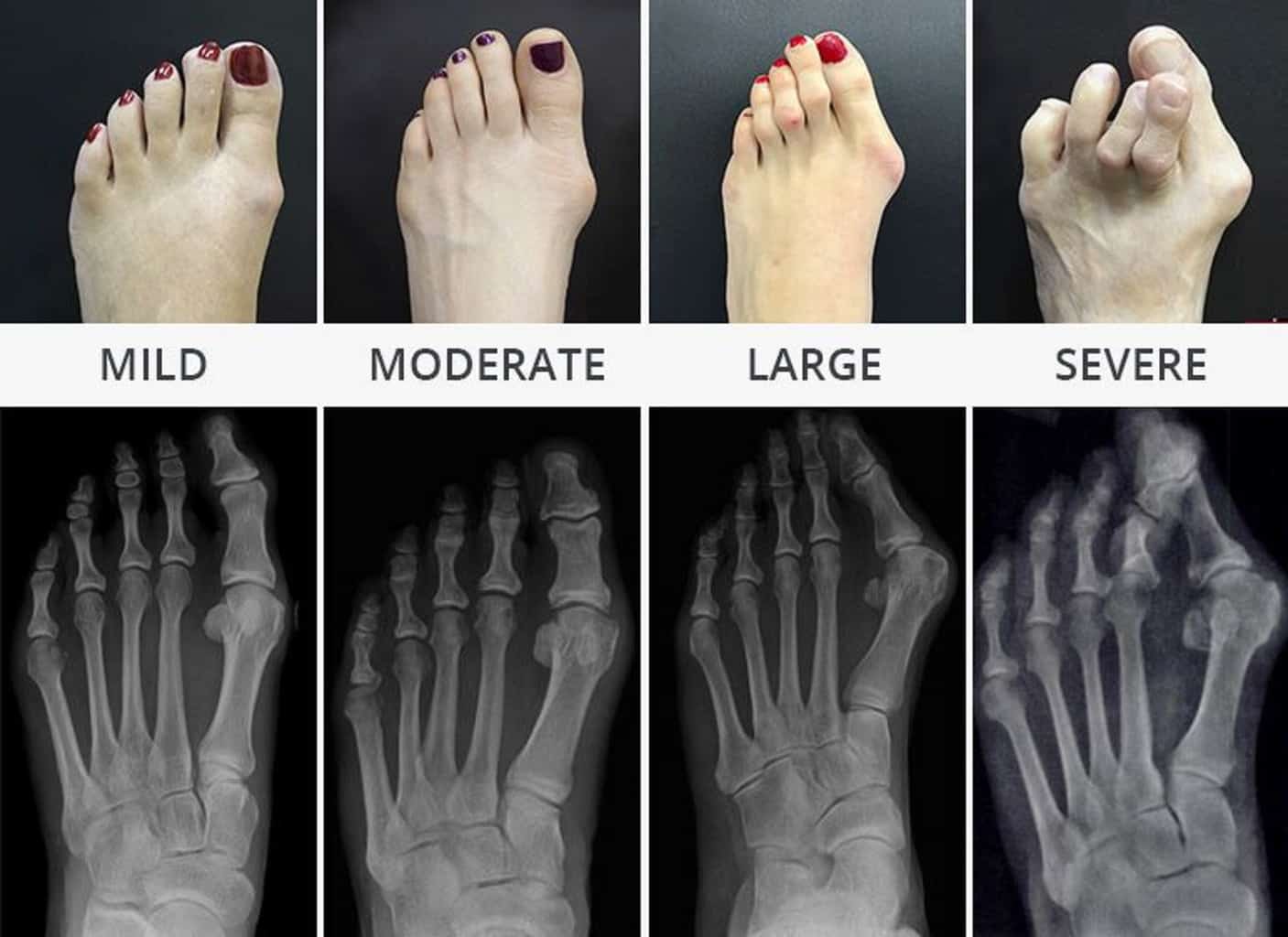 Hammertoe Surgery Center