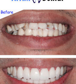 Dental Veneers
