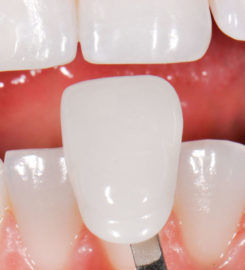 Dental Veneers
