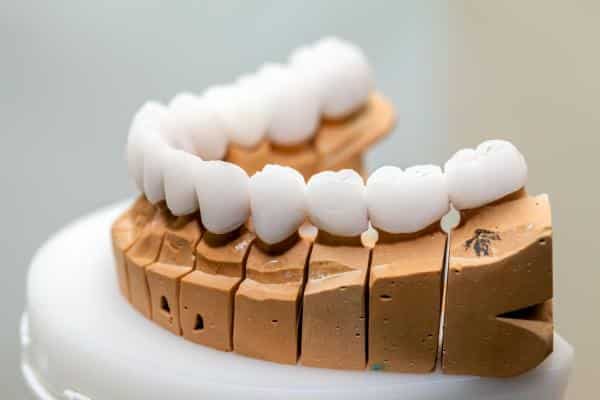 Dental Crowns