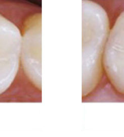 Dental Fillings