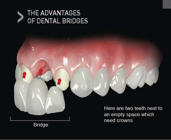 Dental Bridge