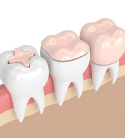 Dental Fillings