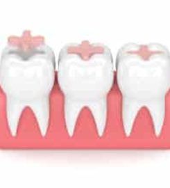 Dental Fillings