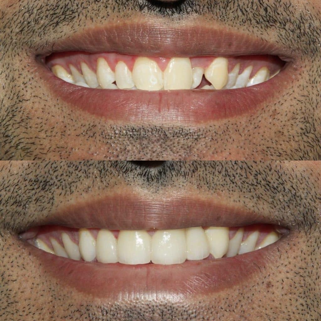 Best Dental Implants