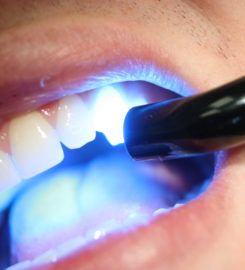 Dental Fillings
