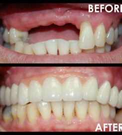 Affordable Dentures