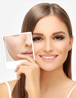 Microneedling with PRP