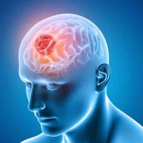 Best Brain Tumor Surgeons in India