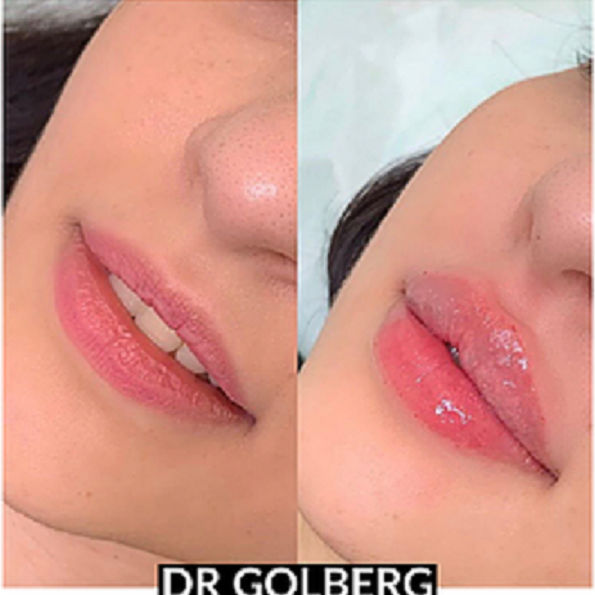 Face Lift Long Island