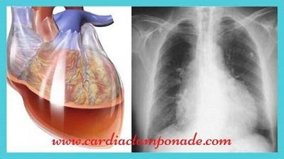 Cardiac Tamponade