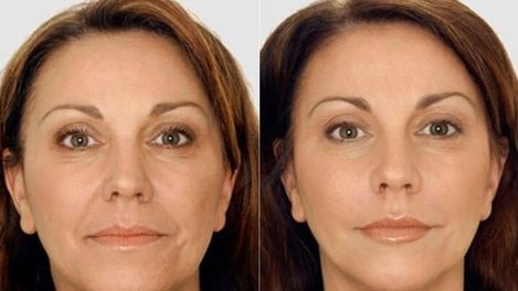 Vampire Facelift