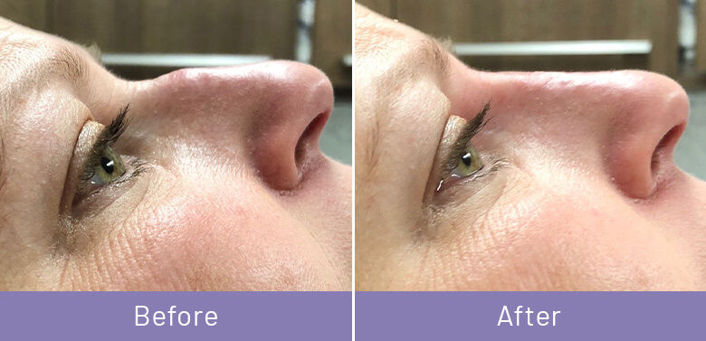 Non-Surgical Fat Removal Ridgewood