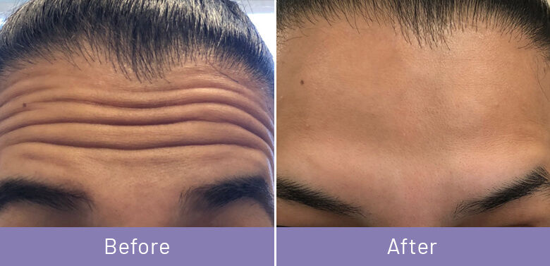 Coolsculpting Bergen County