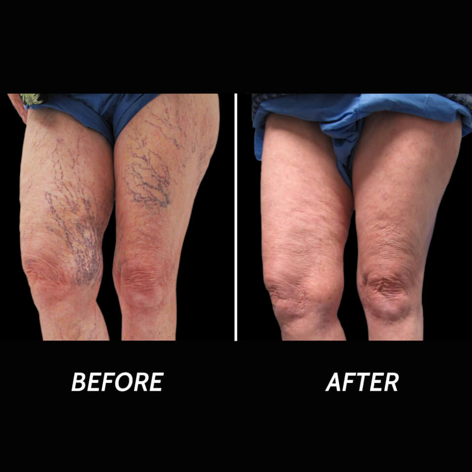 Non-Surgical Fat Removal Paramus