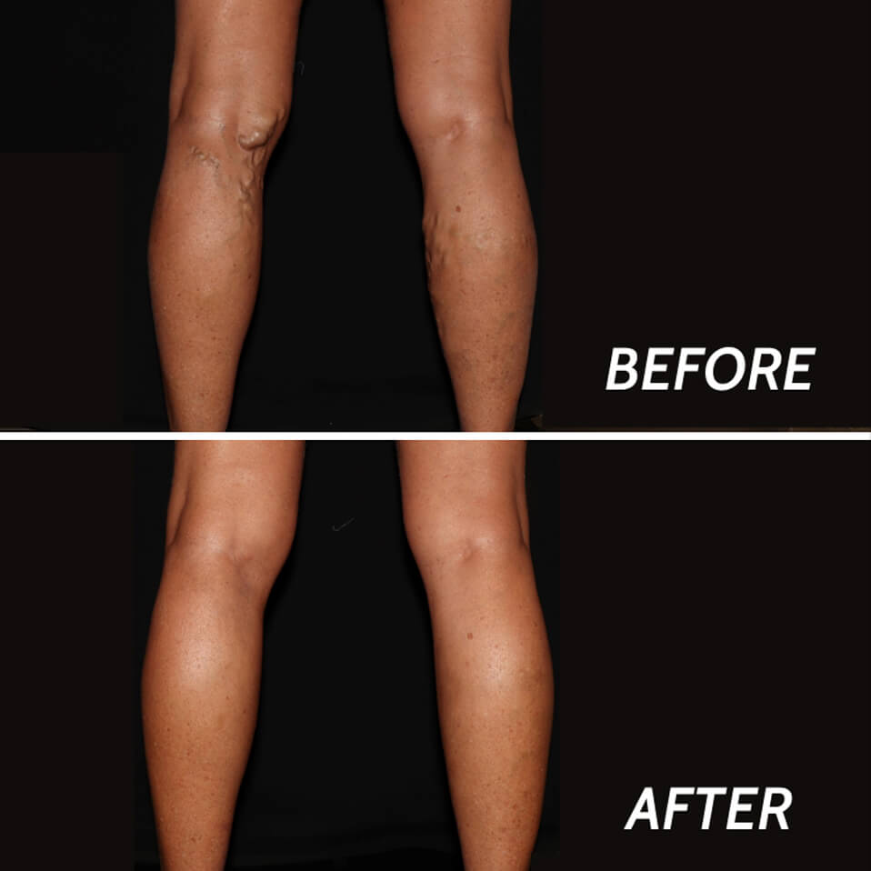 Varicose Veins Paramus