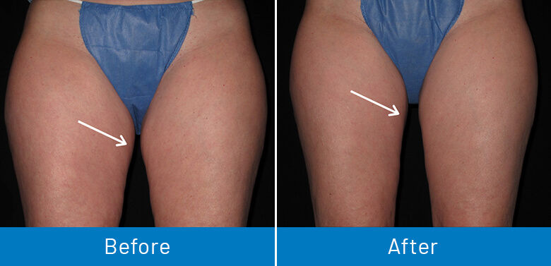 Coolsculpting Paramus