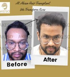 AKESO Hair Transplant