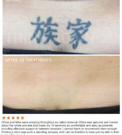 Think Again Tattoo Removal Austin