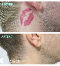 Think Again Tattoo Removal Austin