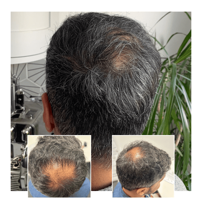 Capital Hair Restoration – Hair Transplant