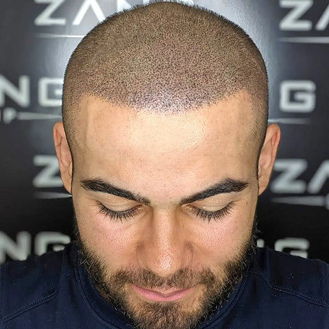 Zang SMP – Scalp Micropigmentation Los Angeles
