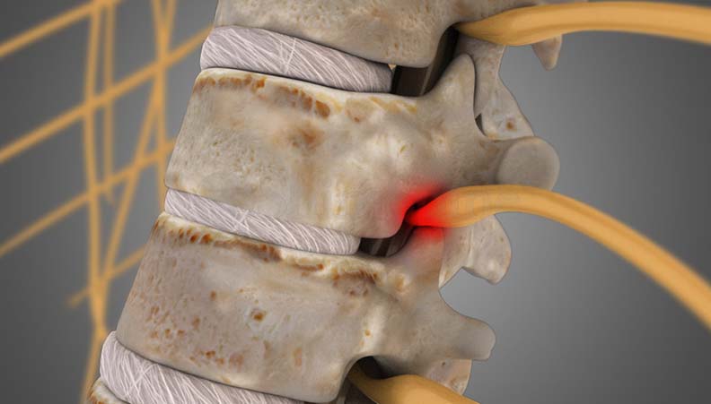 Spine Solutions India – Best Spine Surgeon & Treatment