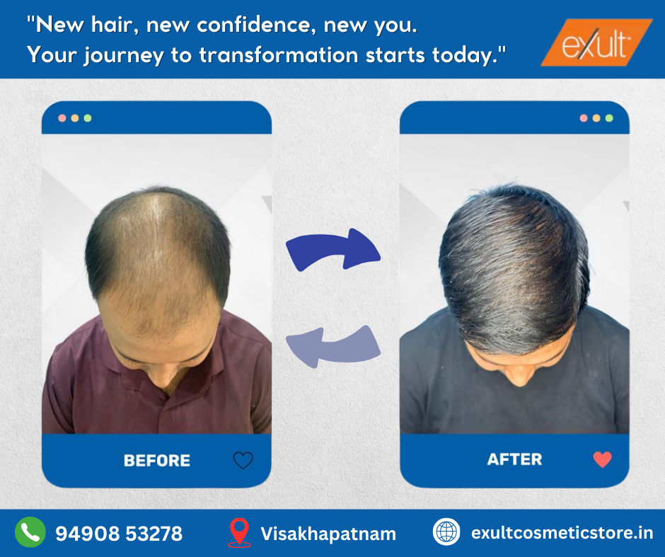 Hair Transplant Surgeon Vizag