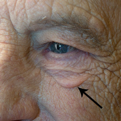 Utah Eyelid & Facial Plastic Surgery | Expert Cosmetic &  &hellip;