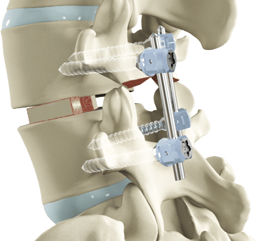 Best Price for Spinal Fusion Surgery in India