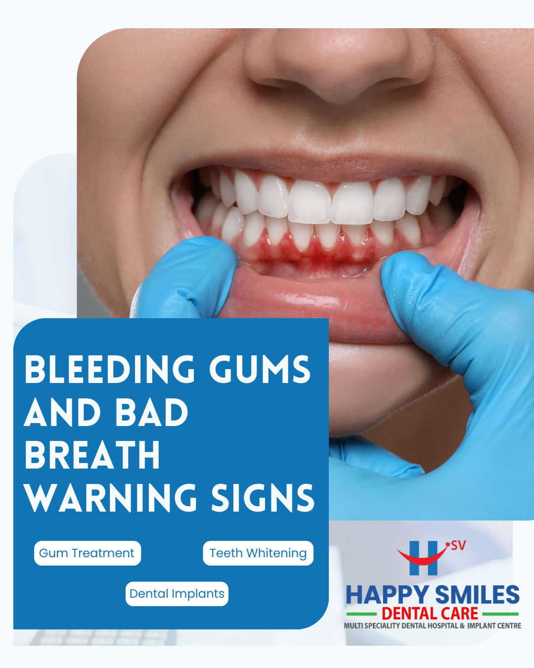 Bleeding Gums and Bad Breath: Early Warning Signs You Should Neve &hellip;