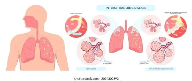 ILD Specialist in Jaipur, Rajasthan | Interstitial Lung Disease T &hellip;