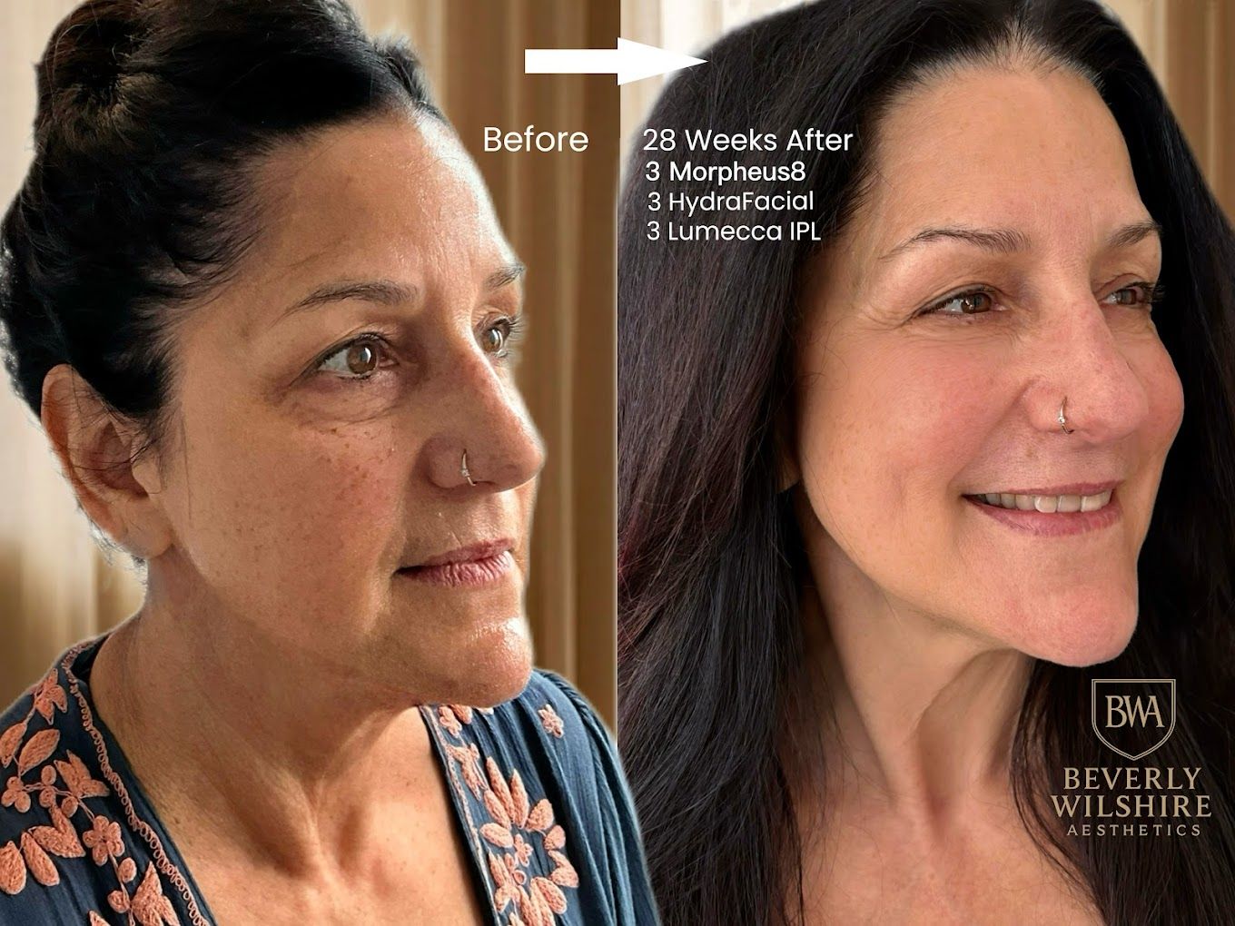 Beverly Wilshire Aesthetics Beverly Hills Medical Spa