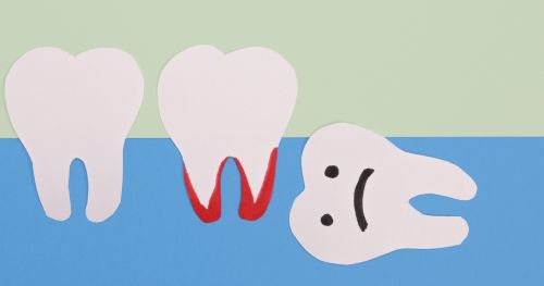 Extraction and Wisdom Teeth Removal 2 Bad Wisdom Teeth Animated Pic