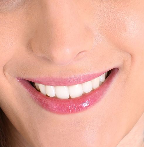 Teeth Whitening 1 closeup of smile with white healthy teeth
